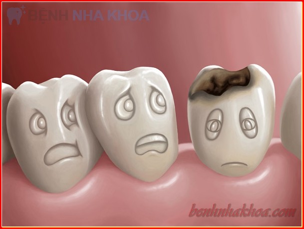 Sâu răng và cách điều trị an toàn hiệu quả
