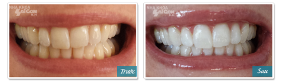 trước và sau khi tẩy trắng răng