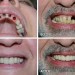 Cấy ghép implant - giải pháp phục hồi răng hiệu quả nhất