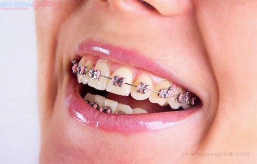 Niềng răng có phải cách chỉnh hàm lệch hiệu quả