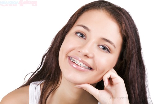 Niềng răng chỉnh anh có lợi ích gì?