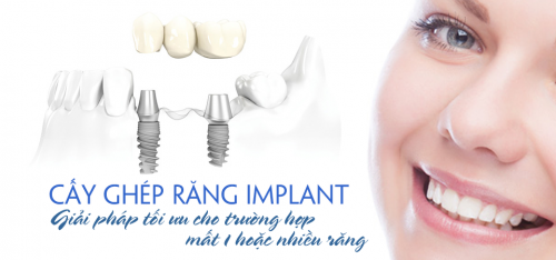 cấy-răng-Implant-khi-bị-mất-răng