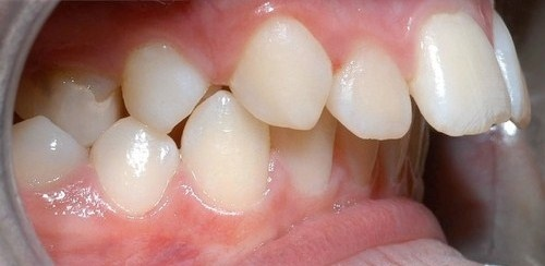 cách hạn chế răng vẩu
