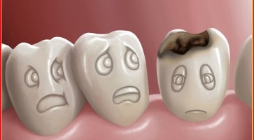 Sâu răng và cách điều trị an toàn hiệu quả