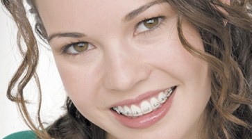 Phương pháp chỉnh nha niềng răng thẩm mỹ có đau không?