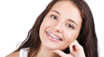 Niềng răng chỉnh anh có lợi ích gì?