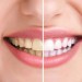 Răng bị lão hóa