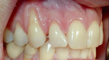 Bạn hiểu gì về bệnh tụt nướu chân răng?